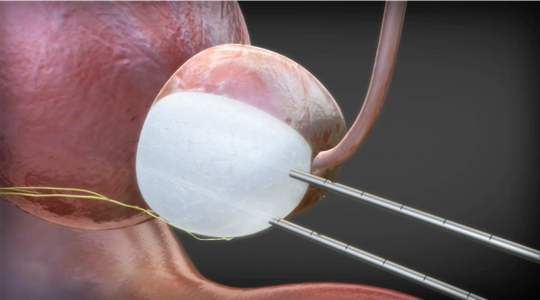 Cryotherapy treatment